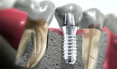 Dental Implants